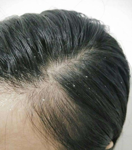 头发出油长痘痘痛怎么办