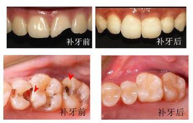 一般补牙需要多少钱