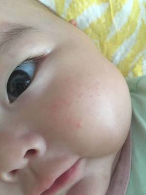 宝宝下巴长痘痘是什么原因