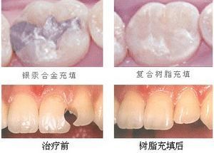 上海补牙多少钱