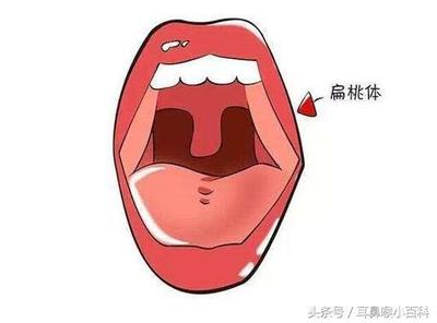 小孩子咽炎该怎么治疗