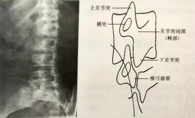 腰5椎弓峡部裂怎么治疗