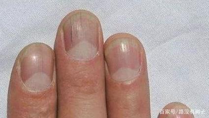 孩子手指甲有竖纹是怎么回事