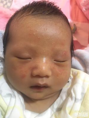 新生儿脸上长痤疮