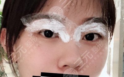 埋线双眼皮能拆吗