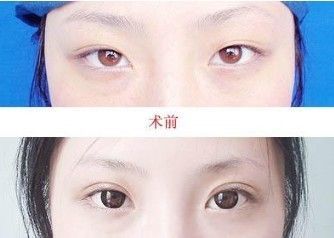 双眼皮风险