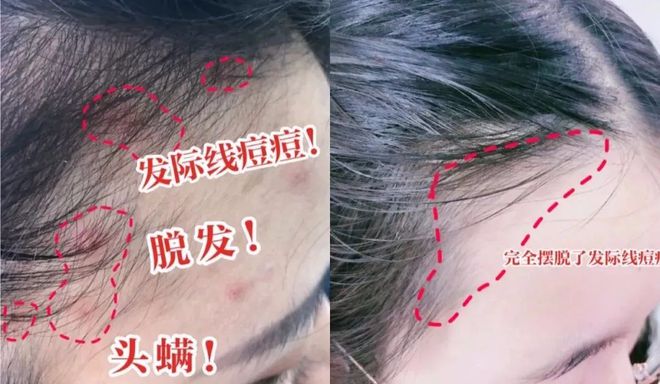 发际线有痘痘