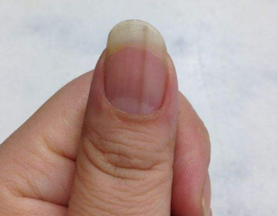 手指甲上有黑色竖纹是怎么回事