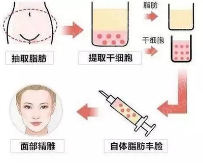 脂肪填充还是玻尿酸好