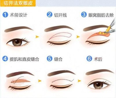 割完双眼皮恢复期