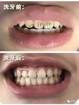 洗牙前要刷牙吗