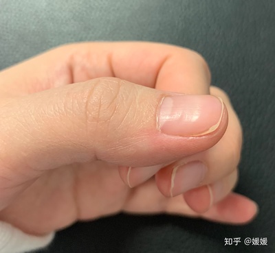 指甲有横纹是怎么回事