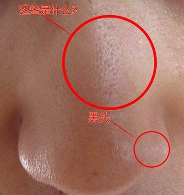 从痘痘里挤出来的是什么