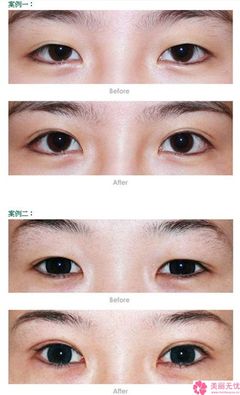 经期做双眼皮