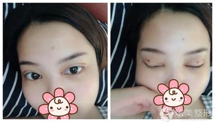 全切双眼皮拆线后