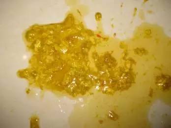 新生儿蛋花样大便