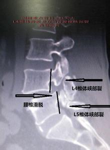 腰5椎弓峡部裂怎么治疗