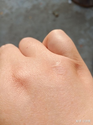 手背疤痕怎么去除