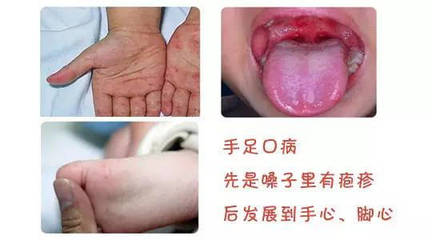 囗腔疱疹怎么治疗