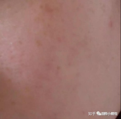 玫瑰痤疮怎么治疗最快