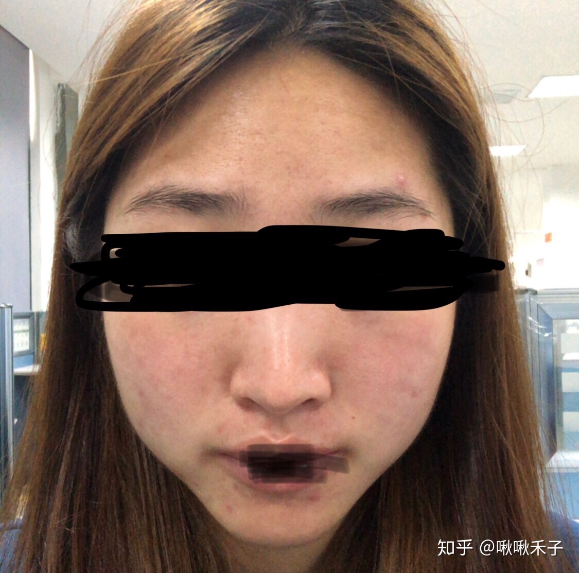 鼻子痘痘好了留下红印