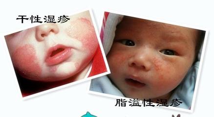 月子里的宝宝湿疹图片