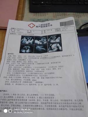 三个月引产要住院吗