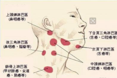 淋巴发炎是怎么回事