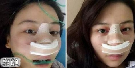 隆鼻后眼睛周围有淤青