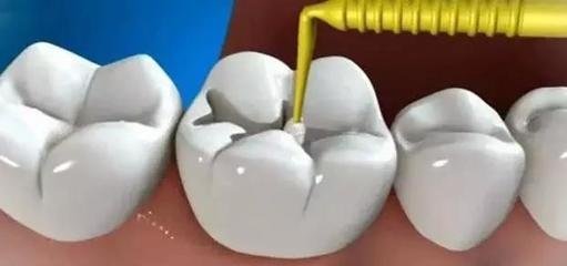 牙疼根管治疗是怎么治疗的