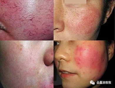 激素脸一保湿就爆痘痘