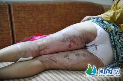 女性拔罐减肥最佳时间
