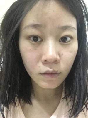 女的脸上长痘痘