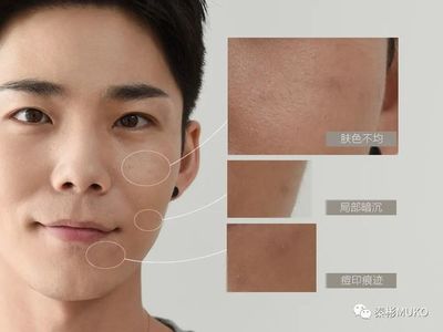 痘印可以自己淡化吗