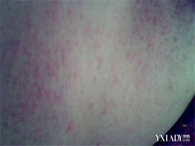 有脓头的痘痘叫什么