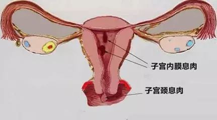 宫颈息肉会影响胎儿吗