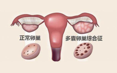 多囊会影响怀孕吗