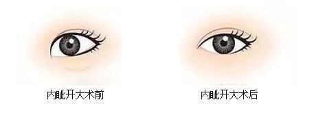 内眦赘皮双眼皮
