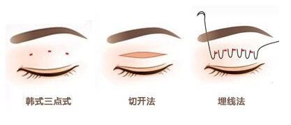 点式双眼皮