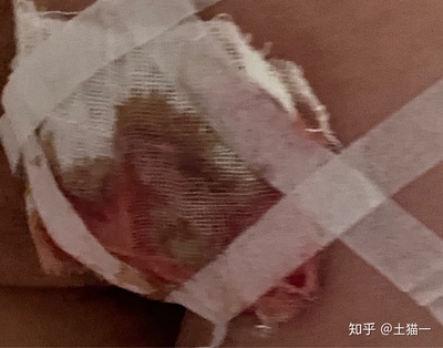 坐板疮怎么治疗