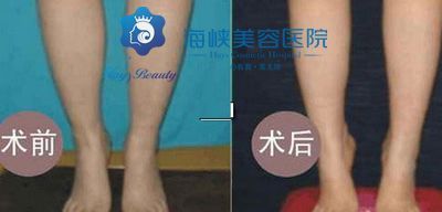 打botox瘦腿针效果好不好