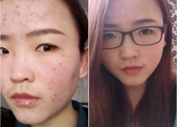 脸上有痘痘可以敷什么