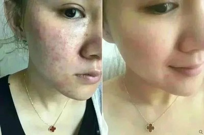 右脸长痘痘是怎么回事啊