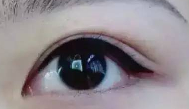 丹东去眼袋价格是多少