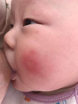 两岁宝宝脸上长痘痘