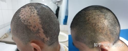 头上有疤痕怎么办