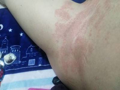 痘痘怎么起的