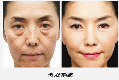 玻尿酸除皱效果能维持多久