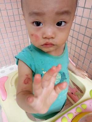 小孩烫伤疤痕怎么办