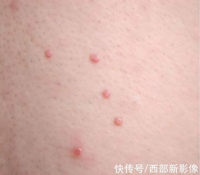 郑州 痘痘